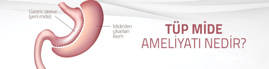 tup-mide-ameliyati-nedir